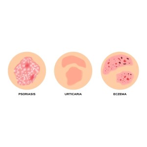 Eczema and Psoriasis