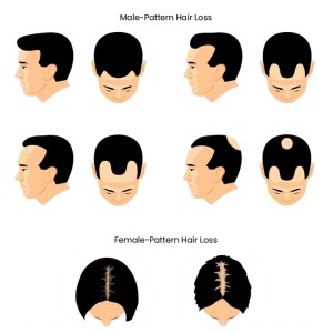 Hair Loss